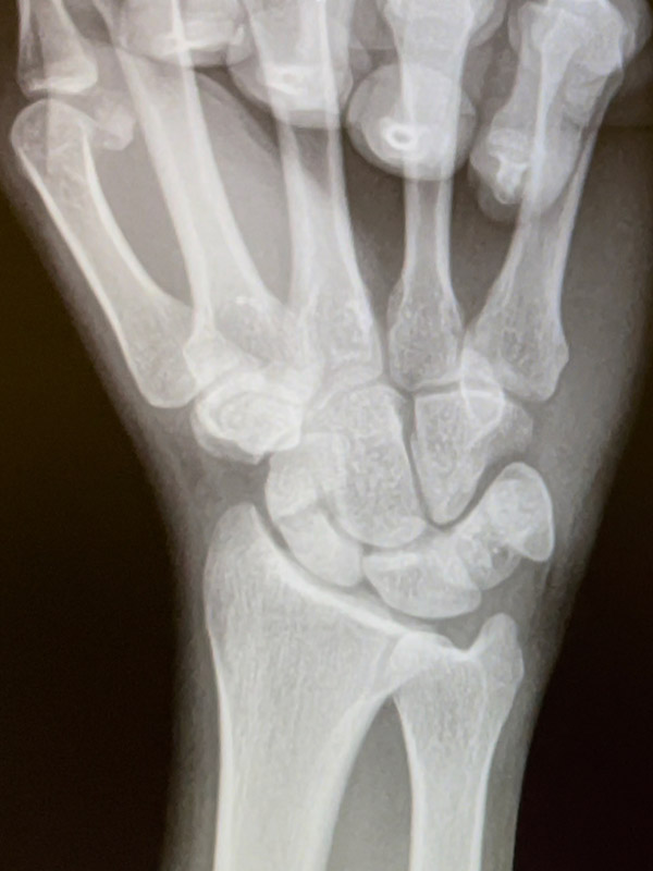 Scaphoid fracture – Photo 01
