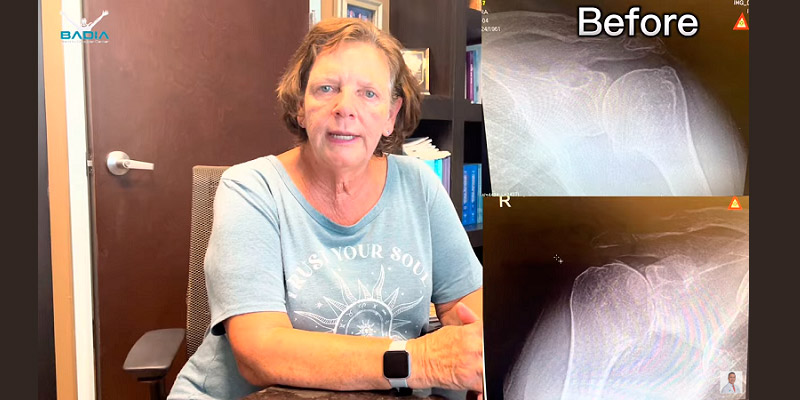 Patient Had Both Her Shoulders Replaced